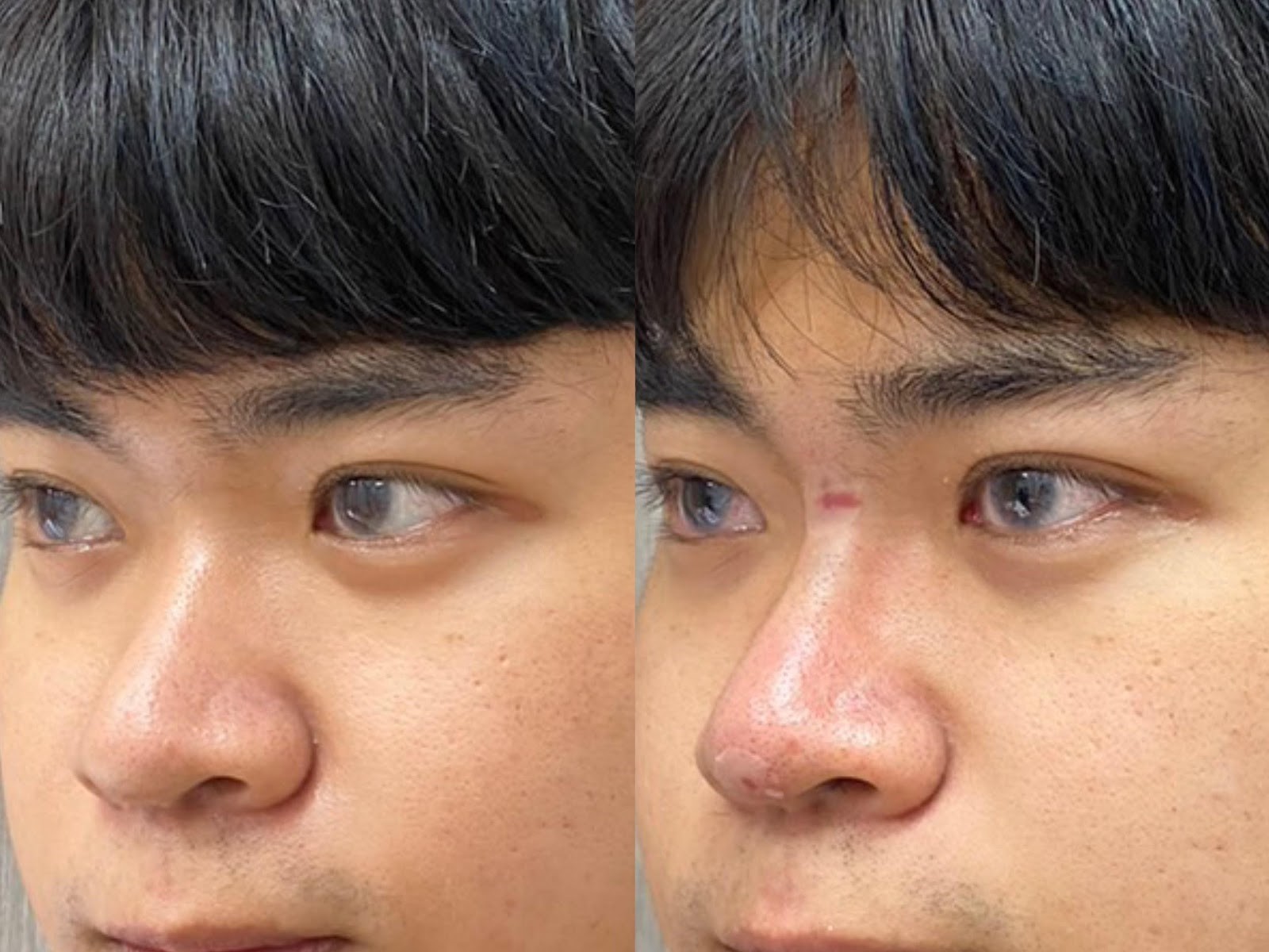 陳裕豪醫師4D三段式埋線隆鼻|皮醫美南勢角診所
