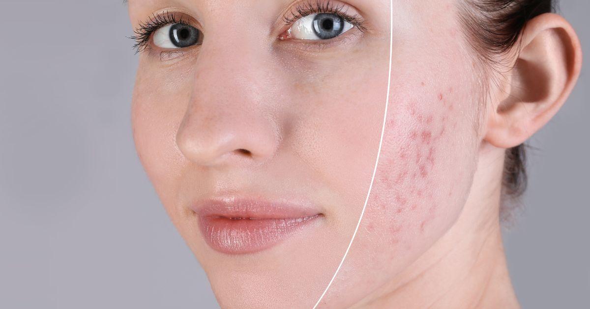 陳裕豪醫師雞尾酒技術皮秒除斑|皮醫美南勢角診所