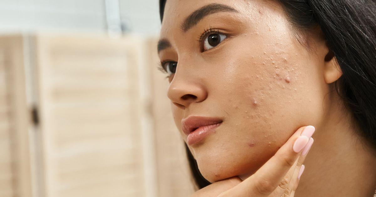 陳裕豪醫師專處理嚴重斑點治療雞尾酒技術皮秒雷射除斑