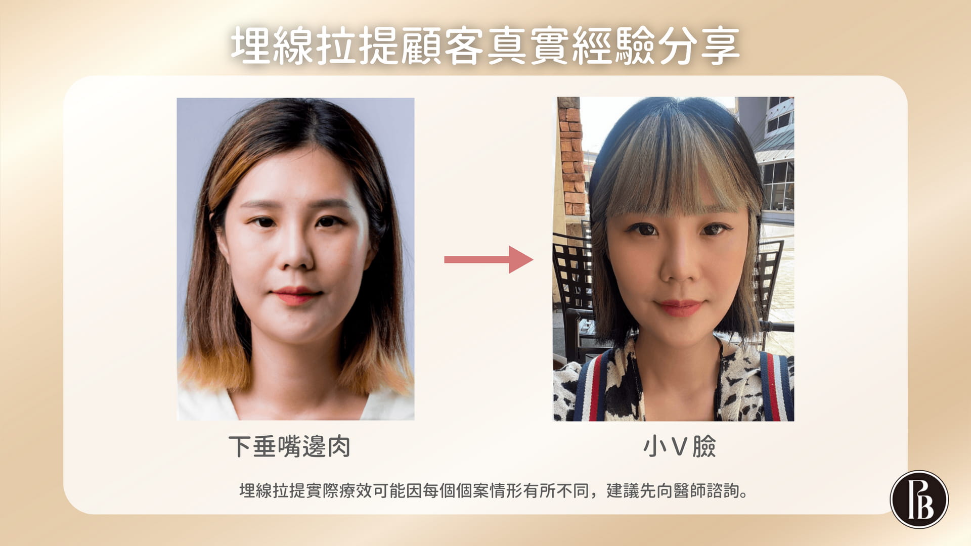 陳裕豪醫師無痛筋膜多層次埋線拉提