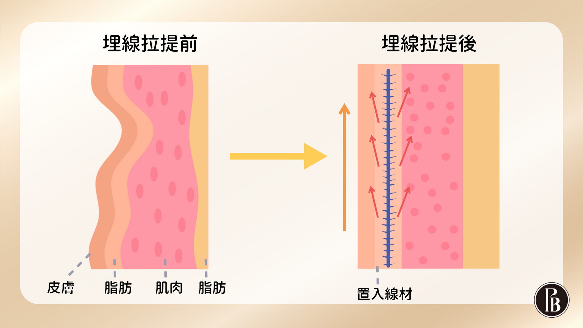 陳裕豪醫師無痛筋膜多層次埋線拉提