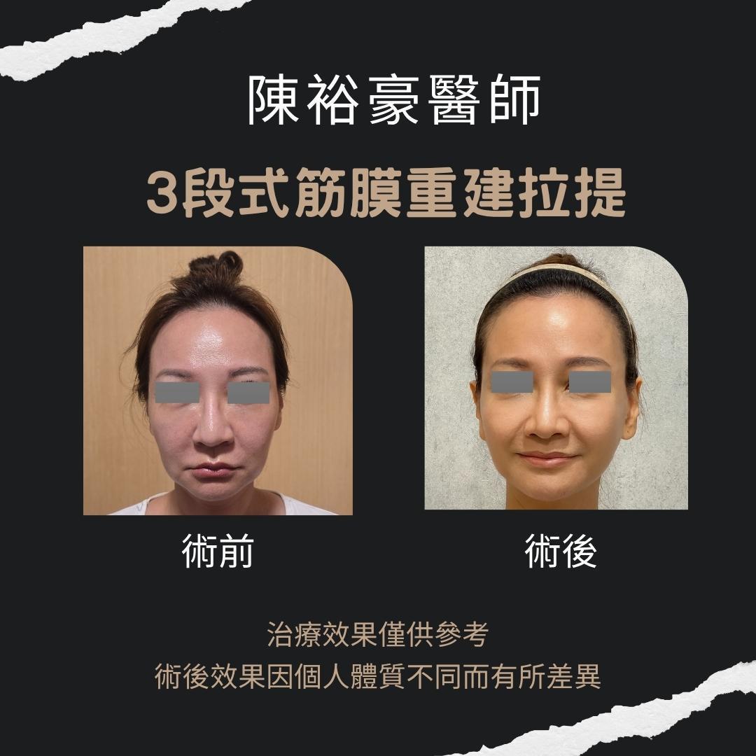 陳裕豪醫師 -筋膜拉提AB3