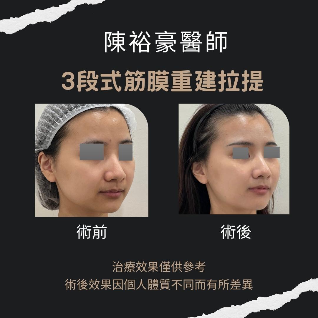 高階抗老 陳裕豪醫師 高階止痛技術-筋膜重建抗老拉提