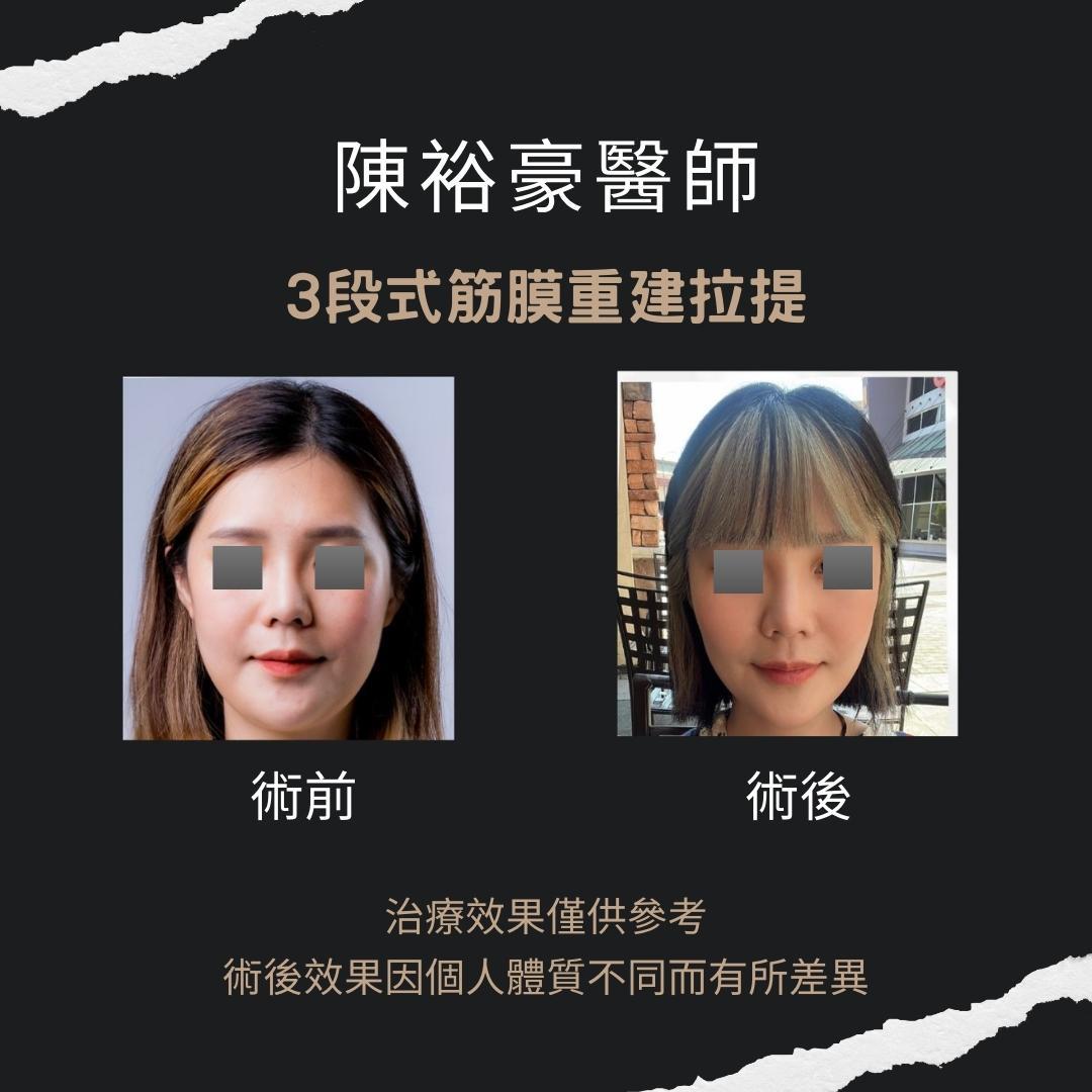 高階抗老 陳裕豪醫師 高階止痛技術-筋膜重建抗老拉提