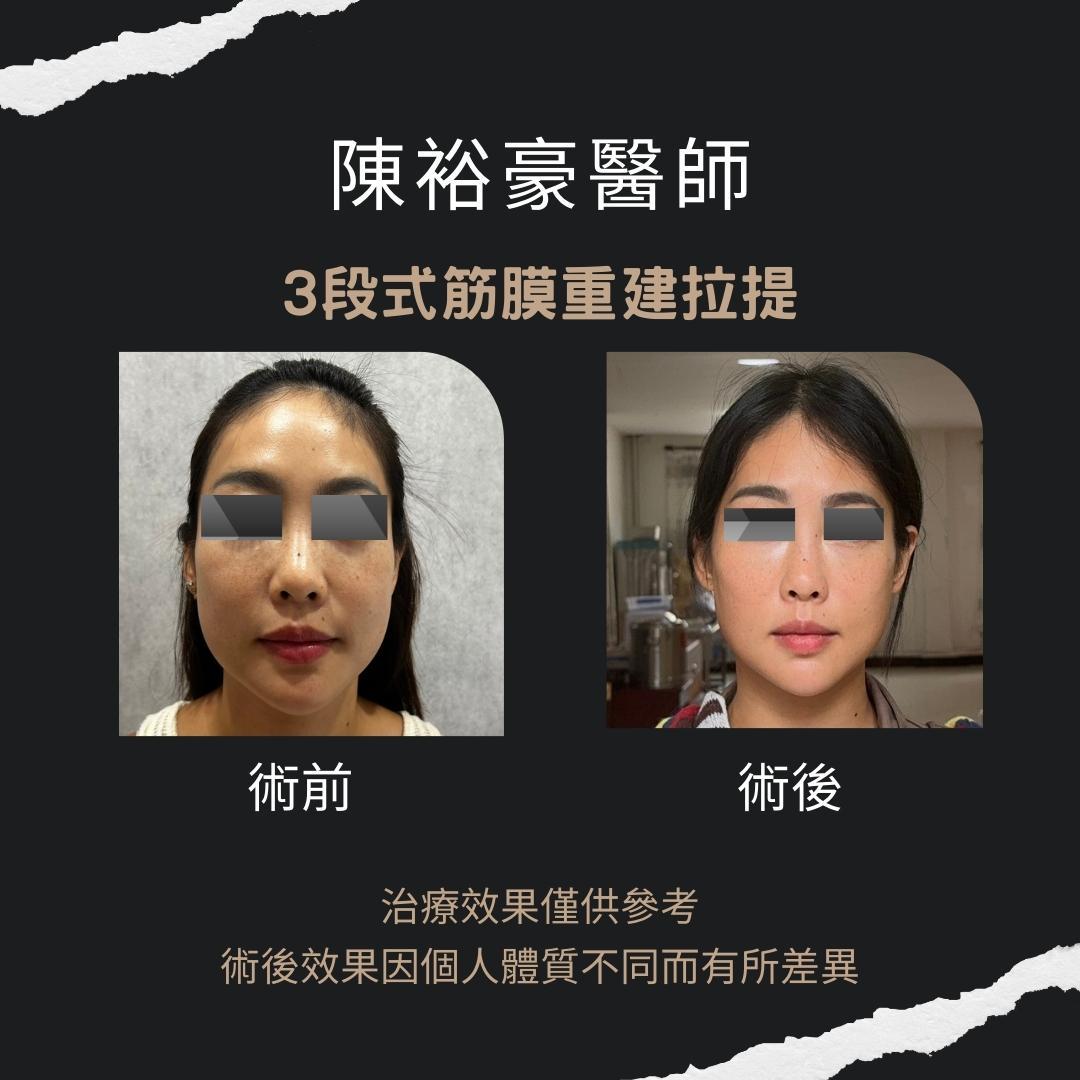 高階抗老 陳裕豪醫師 高階止痛技術-筋膜重建抗老拉提