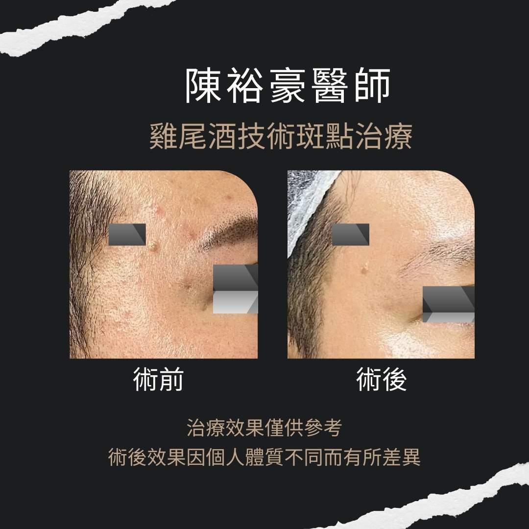 高階抗老陳裕豪醫師-組織重建技術嚴重痘疤治療