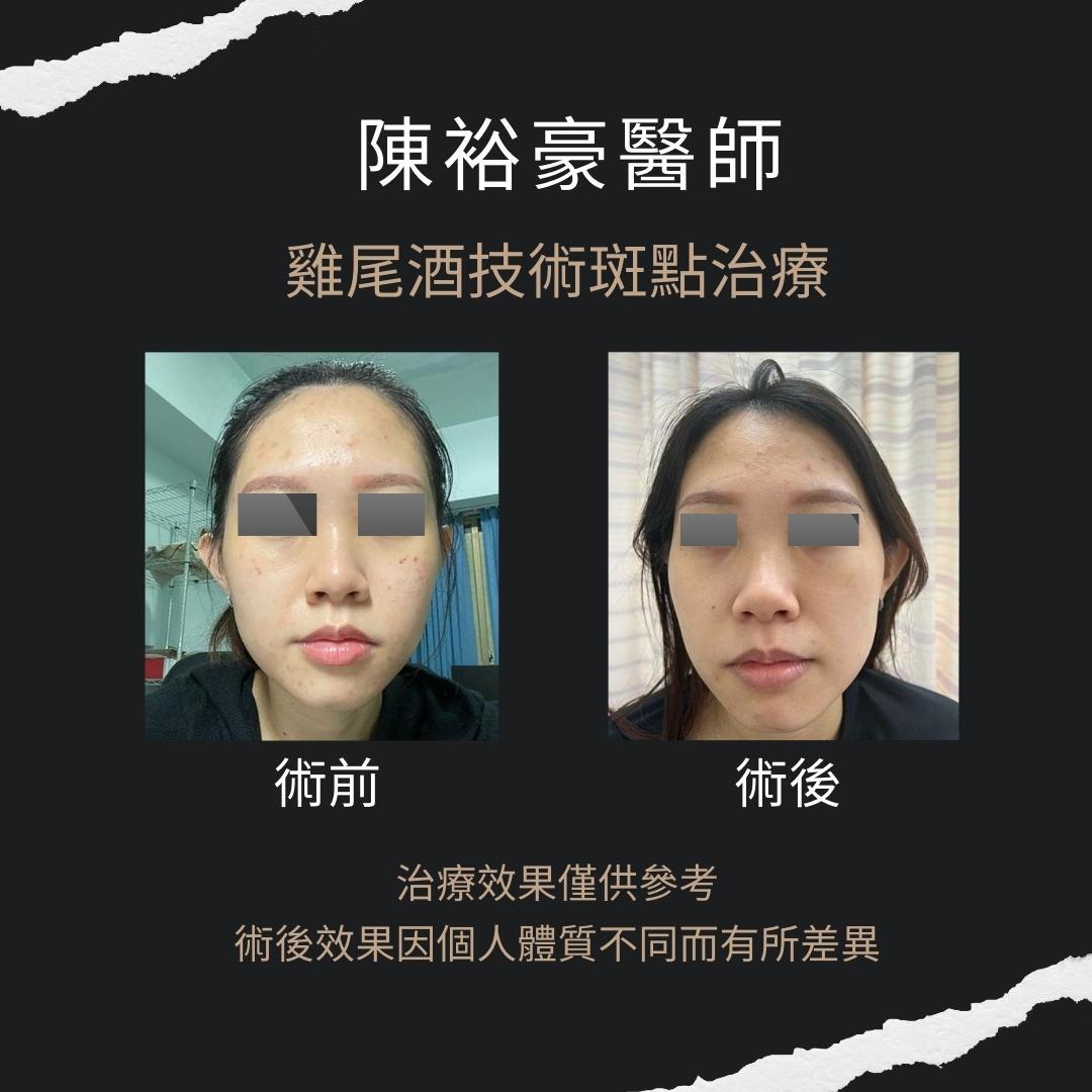 高階抗老 陳裕豪醫師-雞尾酒技術反黑嚴重肝斑治療