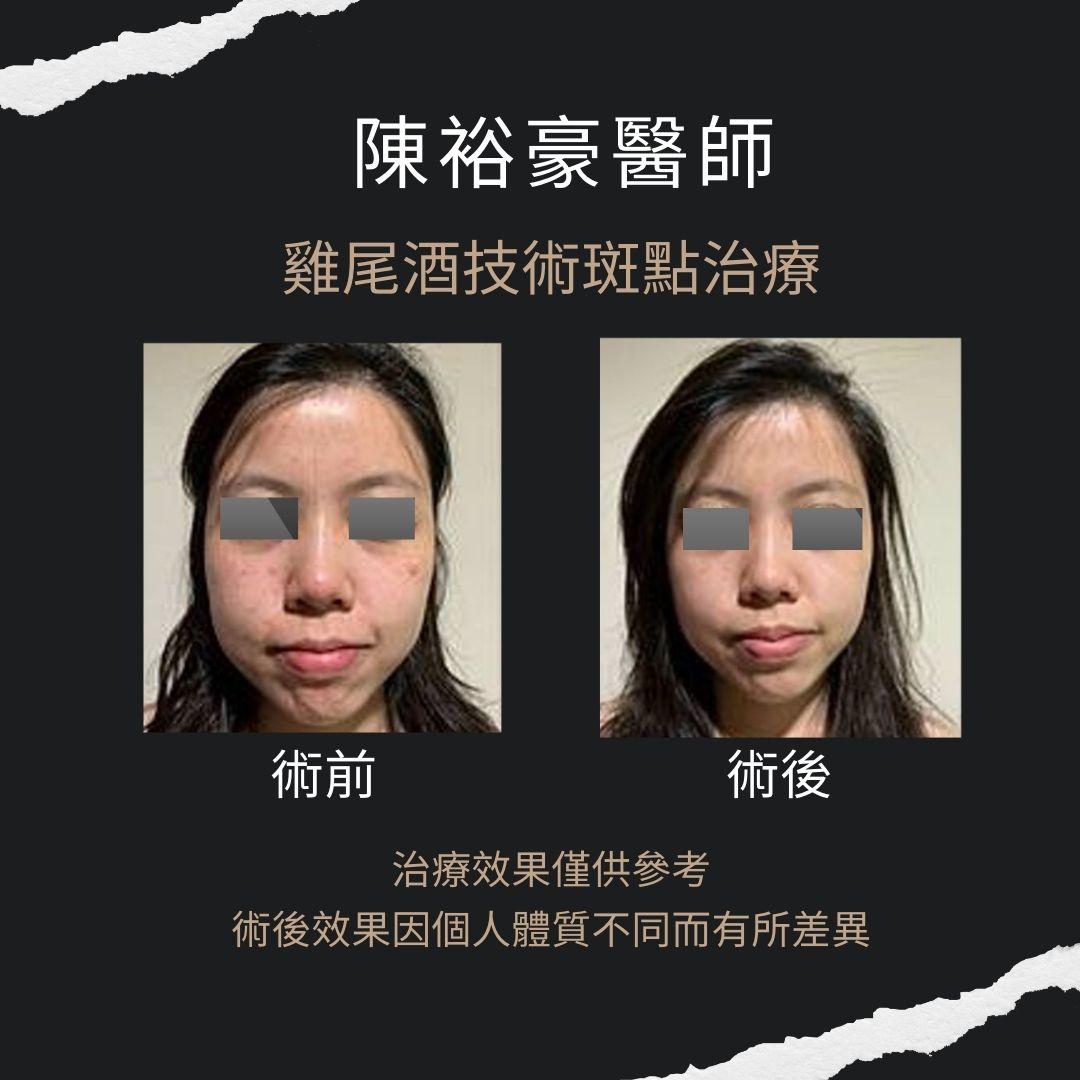 高階抗老 陳裕豪醫師-雞尾酒技術反黑嚴重肝斑治療