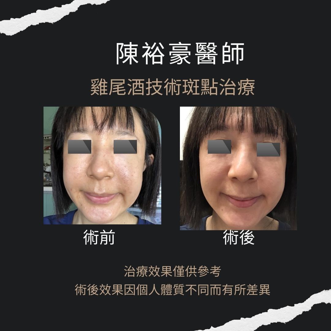 高階抗老 陳裕豪醫師-雞尾酒技術反黑嚴重肝斑治療