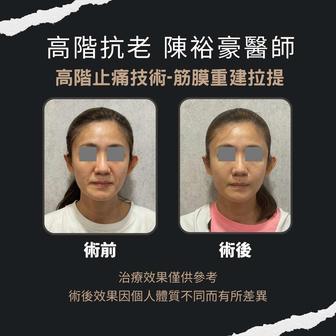高階抗老 陳裕豪醫師 高階止痛技術-筋膜重建抗老拉提