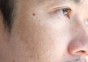 陳裕豪醫師雞尾酒技術皮秒除斑|皮醫美南勢角診所