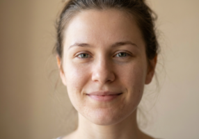 年輕西方女性素顏凹陷_近照_600x400