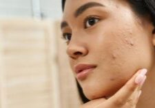 陳裕豪醫師專處理嚴重斑點治療雞尾酒技術皮秒雷射除斑